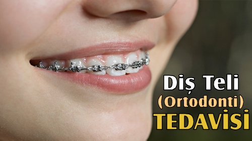 Ortodonti Di Tel Tedavileri